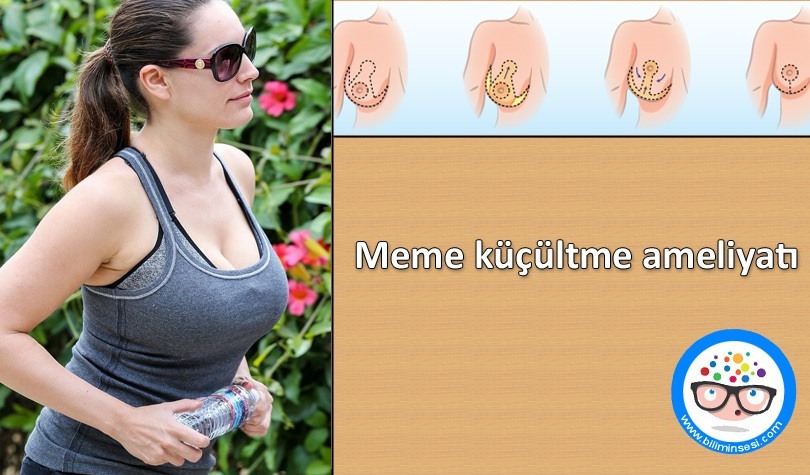 meme küçültme ameliyatı