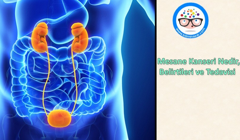 Mesane Kanseri Tedavisi
