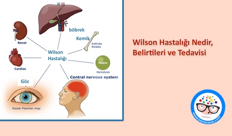 Wilson Hastalığı Nedir