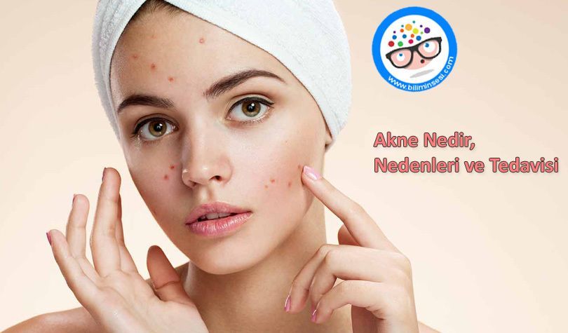 akne tedavisi