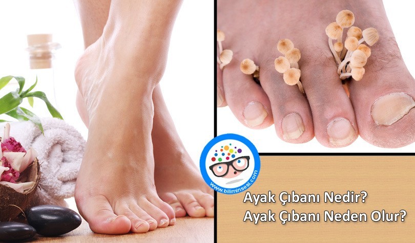 Ayak Çıbanı Nedir- Ayak Çıbanı Neden Olur
