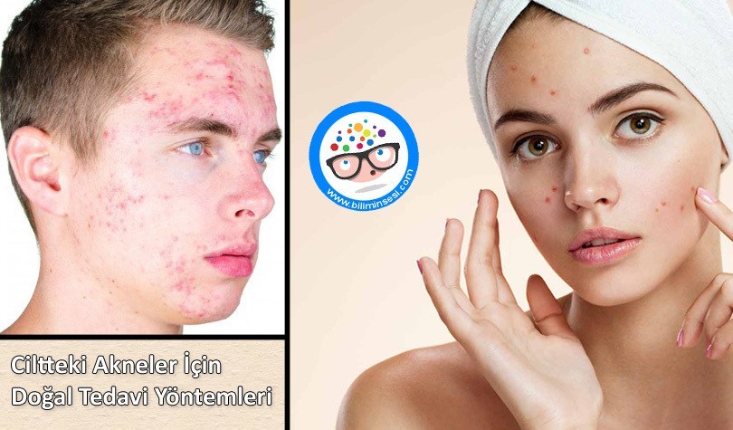 Ciltteki Akneler İçin Doğal Tedavi Yöntemleri