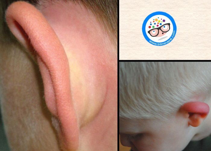 Kulak Kızarması Neden Olur-Kızarıklık Sebebi