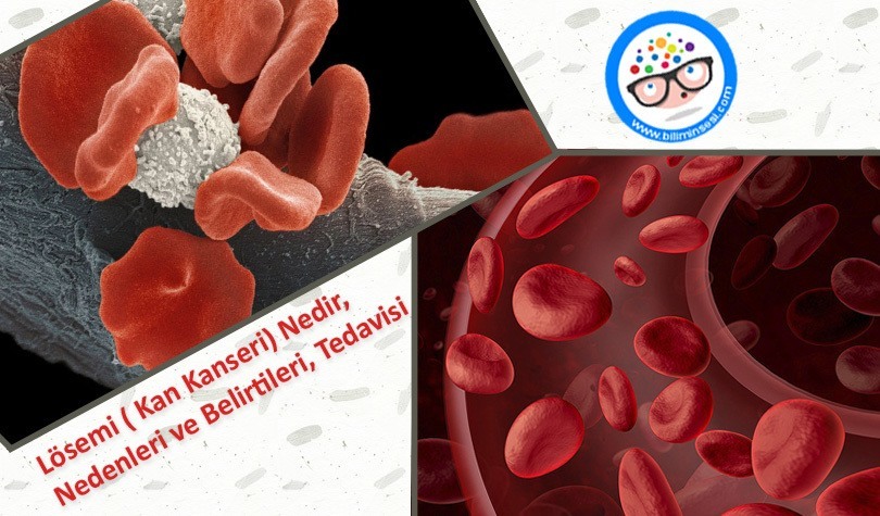 Lösemi Tedavisi