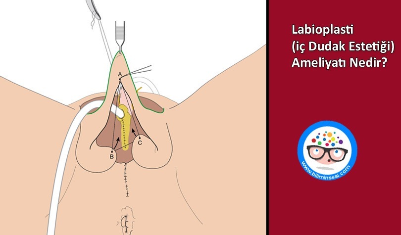 Labioplasti (iç Dudak Estetiği) Ameliyatı Nedir