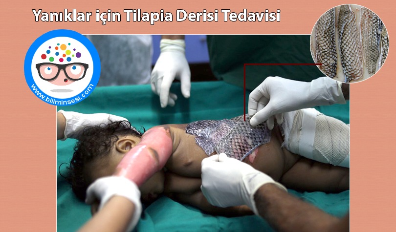 Yanıklar için Tilapia Derisi Tedavisi